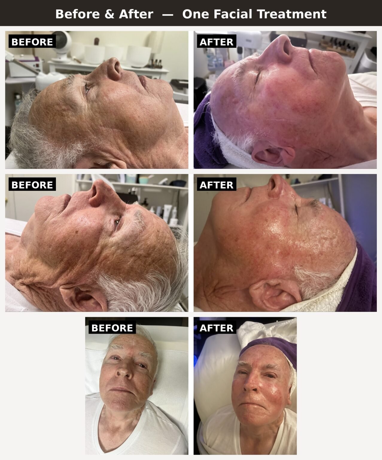 Before and after photos of Kath's 86-year-old father after one Signature Hydrofacial at Massage by Kath in Newtown, CT, showing smoother, more hydrated skin